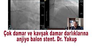 çok damar ve kavşak damar darlık tıkanıklıklarına anjiyo balon stent