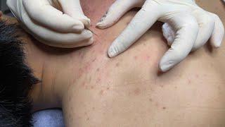 ACNE TREATMENT WITH VU QUYNH MI| Acne  Squeeze For Boy's Back 2023