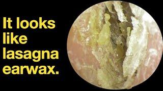 It looks like lasagna earwax. |ear wax removal | ear cleaning | ASMR | relaxation | relax