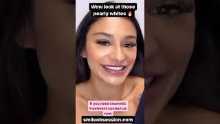 GLO Teeth Whitening Review Before And After  | Smile Obsession Experience