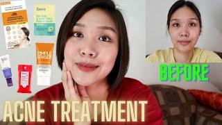 EFFECTIVE ACNE TREATMENT (NO NEED TO GO TO THE DERMA!) | lovewendyxdiane