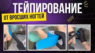 Тейпирование от вросших ногтей