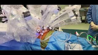 Cerfolio Surgery: Chest Tubeless & Chest Incisionless Subcostal Multi-Arm Robotic Lung Resection