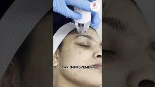 MNRF treatment. Book your appointments now #cosmetology #microneedling #miraroad #trichology