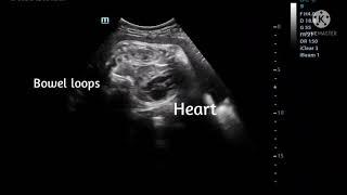 Fetal diaphragmatic hernia deviating heart to the left side.