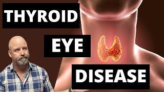 Thyroid Eye Disease: Symptoms, Treatments, and How to Fix Dry Eye Issues