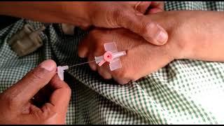 IV Cannulation Procedure