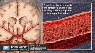 Cerebral Small Vessel Disease Leading to Ischemic Stroke