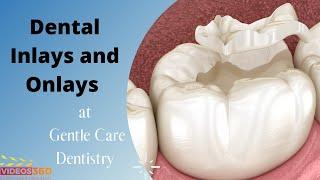 Dental Inlays and Onlays explained by Dr. Brianne Luu