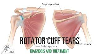 Rotator cuff tear: Signs and symptoms, diagnosis and treatment options for these shoulder injuries