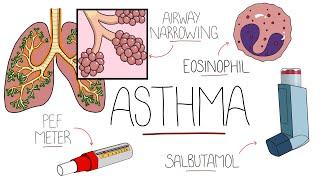 Asthma Explained (Including Pathophysiology)