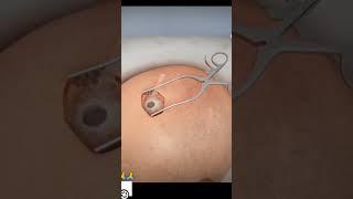 Ventriculostomy: 3D animation af the surgical procedore #3danimation #shortsvideo #3danimationvideos