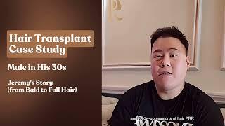 Hair Transplant Case Study - Peters Radiant Clinic