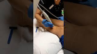 Laser Hair Removal