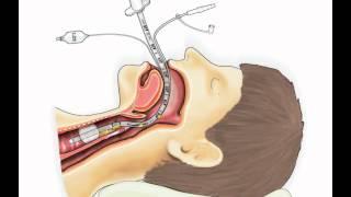 Эндотрахеальные трубки