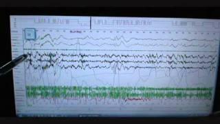 Sleep Study Scoring on Person with Severe Sleep Apnea and snoring. Polysomnograph