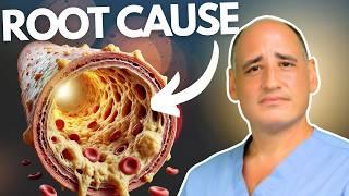 SHOCKING TRUTH About Cholesterol & Carnivore Diet! (Heart Surgeon)