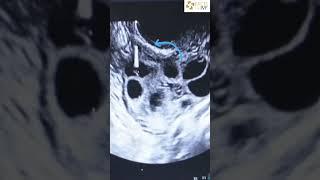 From Follicles to Fertility: The Egg Retrieval Journey! ️Dr Rhythm Gupta -IVF specialist #ytshorts