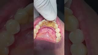 Teeth mobility #dentistteeth #dentist #dentaltreatment