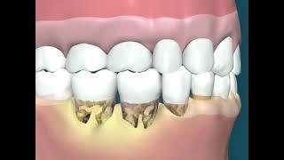 Dental Video of Pocket formation with Calculus