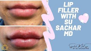 My Lip Filler Experience With Dr. Sachar!