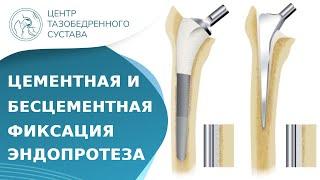  В чем отличие цементной фиксации от бесцементной? Цементное и бесцементное эндопротезирование. 18+