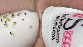 ACNE CLEANING - KINISH TV  #kinishacne 2023 new video #7