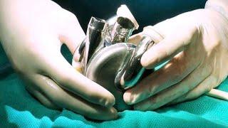 The Texas Heart Institute Implants BiVACOR® Total Artificial Heart