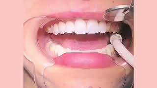 Miami Porcelain Veneers Try in - Dr.Svetlana Anokhina DDS