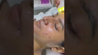 Hydra Facial Treatment For acne Skin, HydraFacial For winters #hydrafacial #facialfordryskin #salon