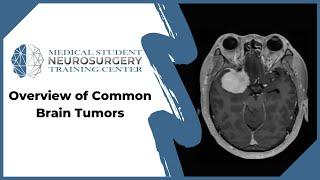 Overview of Common Brain Tumors