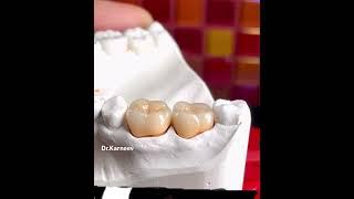 Gangsta dental crowns )