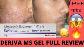 Deriva MS Gel Full review Effects and Side Effects Best for Acne Pimples पिम्पल्स गायब