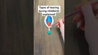 Types of tearing during childbirth EXPLAINED! #pregnancy