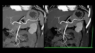 CT Evaluation of the Spleen: Challenges in Diagnosis Part 1