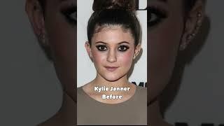 KYLIE JENNER before and after her plastic surgery #trending