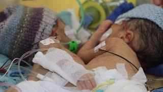 'Youngest' conjoined sisters separated at Swiss hospital in Bern