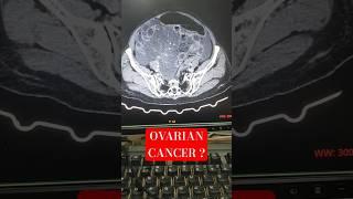 Ovarian cancer ? #diagnosis #radiology #ovariancancer #ovarian #pelvis #xray ‎⁨@hemantkushwah3453⁩ 
