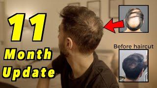 11 Month 2nd Hair Transplant Update | 4000 GRAFTS FUE | I MESSED UP (bad haircut)