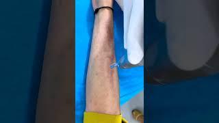 Laser treatment for lichen Planus Pigmentosus Treatment | Skinaa Clinic #viral #viralshort