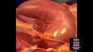 Stomach Inflation due to Esophageal Intubation