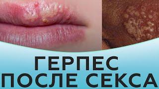 Герпес после секса