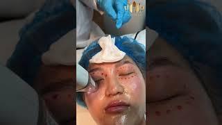 [Lemed Clinic] Potenza Vampire Facial