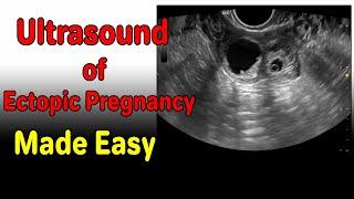 Ultrasound of Ectopic Pregnancy Made Easy