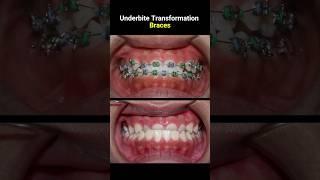 Underbite braces transformation #braces #orthodontist #dentist #bracket