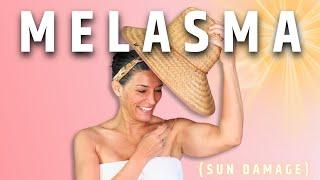 A Master Esthetician's Solution to Melasma | Peaches Skin Care