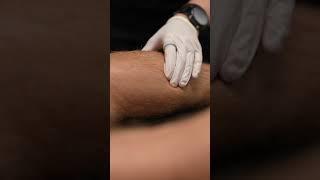 ️ Dry Needling Tight Calves #dryneedling #physicaltherapy #runner #sports #muscle #needles