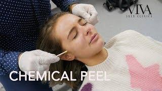 VIVA SKIN CLINICS | CHEMICAL PEEL