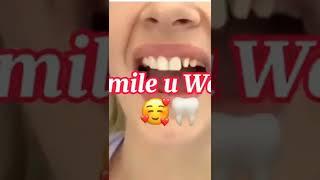 How Veneer are Placed|How Veneer put on Tooth|Veneer Placement|Ur Smile is Important To us