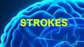 Strokes & The Rule of 4s || USMLE